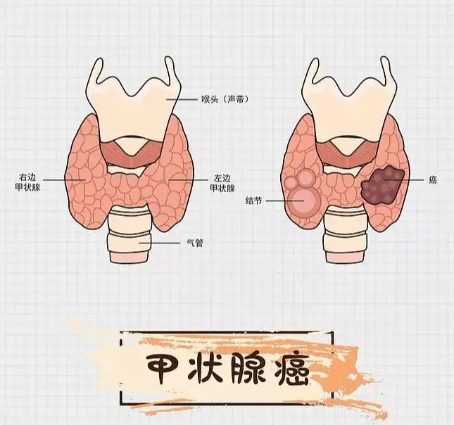 杭州中医治疗结节：患上甲状腺结节 不算摊上大事